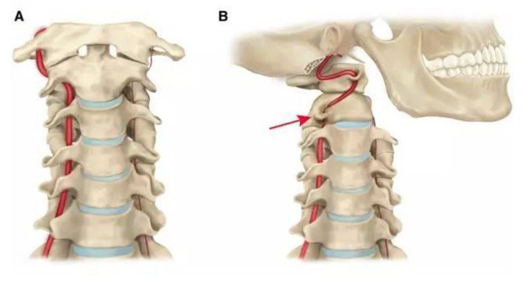 椎動脈在進入顱內前的顱底段會呈現兩處彎折。正常轉頭時，頭顱骨和上段頸椎骨會旋轉開...