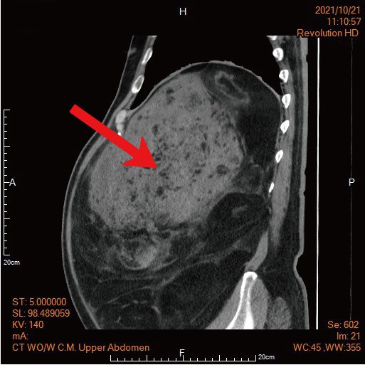 腹部電腦斷層影像發現楊先生的腫瘤巨大，連脊椎都受到壓迫。圖／馬偕醫院提供