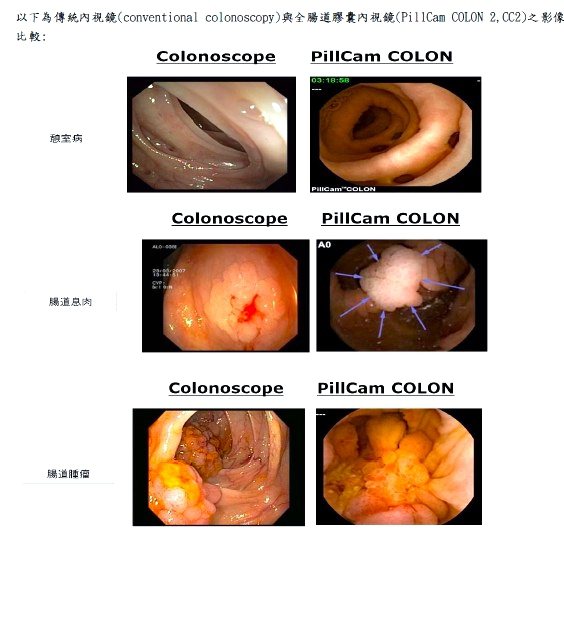 全腸道檢查的「膠囊內視鏡」拍攝的影像（右排）較傳統胃鏡拍攝畫面（左排）毫不遜色，且張數更多。圖／中山醫學大學附設醫院提供