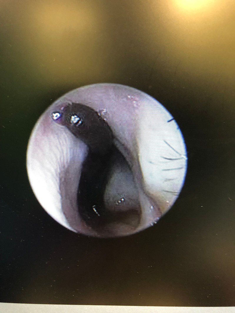 醫師在余姓女童鼻腔裡發現2公分長的鼻蛭，確認是女童流鼻血的主因。圖／花蓮慈濟醫院提供