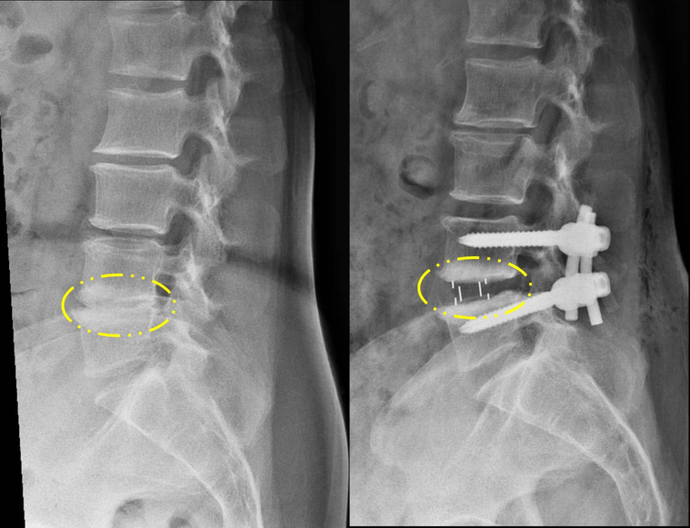 蕭婦接受新式手術（右），撐開椎間盤空間，不再壓迫神經。圖／彰化醫院提供