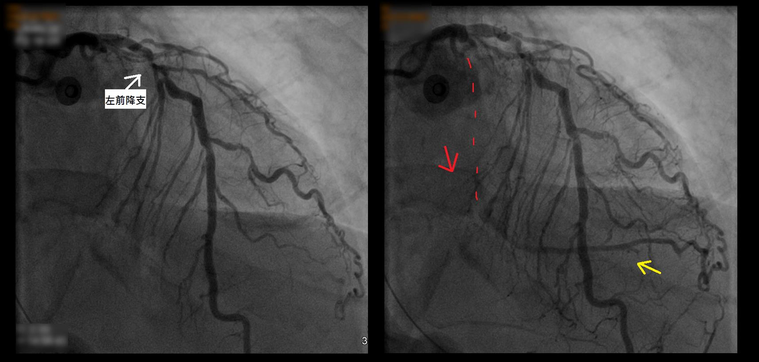 左：透過心臟冠狀動脈攝影，可看到病患術前冠狀動脈左前降支嚴重狹窄；左迴旋支則因完...