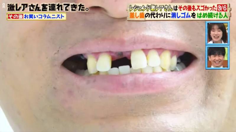 Yoshimatsu用橡皮擦自制门牙，图为装上「橡皮擦门牙」前。图／《激レアさんを连れてきた》截图(photo:UDN)