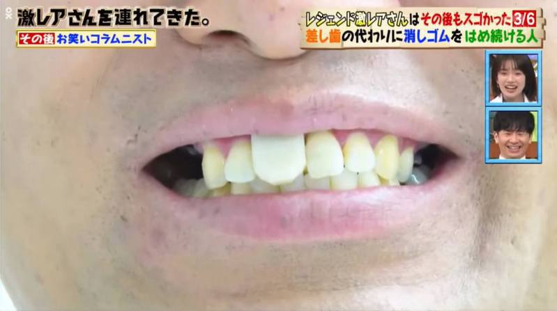 Yoshimatsu用橡皮擦自制门牙，图为装上「橡皮擦门牙」后。图／《激レアさんを连れてきた》截图(photo:UDN)