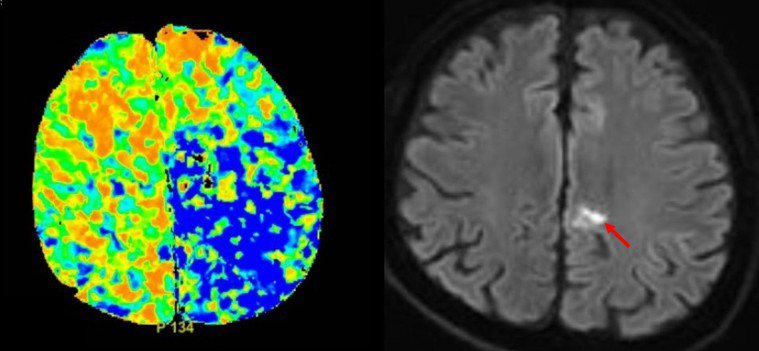 左圖藍色區域為大腦缺血區，若無有效治療，則該區域將出現大範圍大腦壞死。右圖可見，...