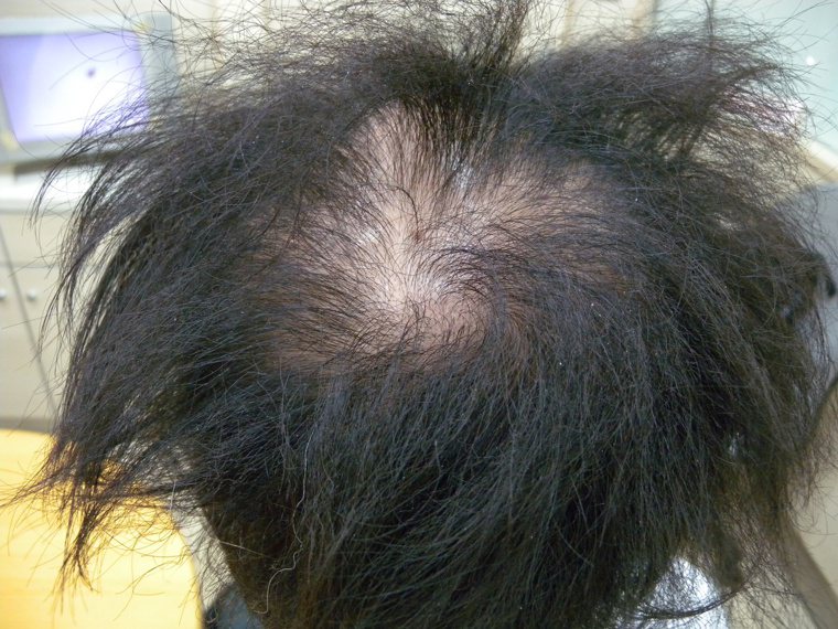 30多歲型男不當染髮引起紅腫過敏潰爛。圖／樂活健康診所提供