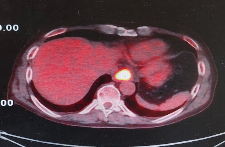 癌細胞（中間黃圓點）尚未由淋巴結轉移，病患手術後恢復良好。圖／大千綜合醫院提供