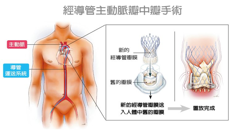 經導管主動脈瓣中瓣手術 圖╱陳紹緯提供