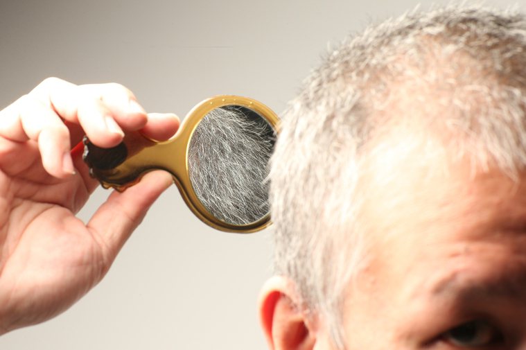 頭頂髮量稀疏到可看到頭皮，小心掉髮危機。本報資料照片