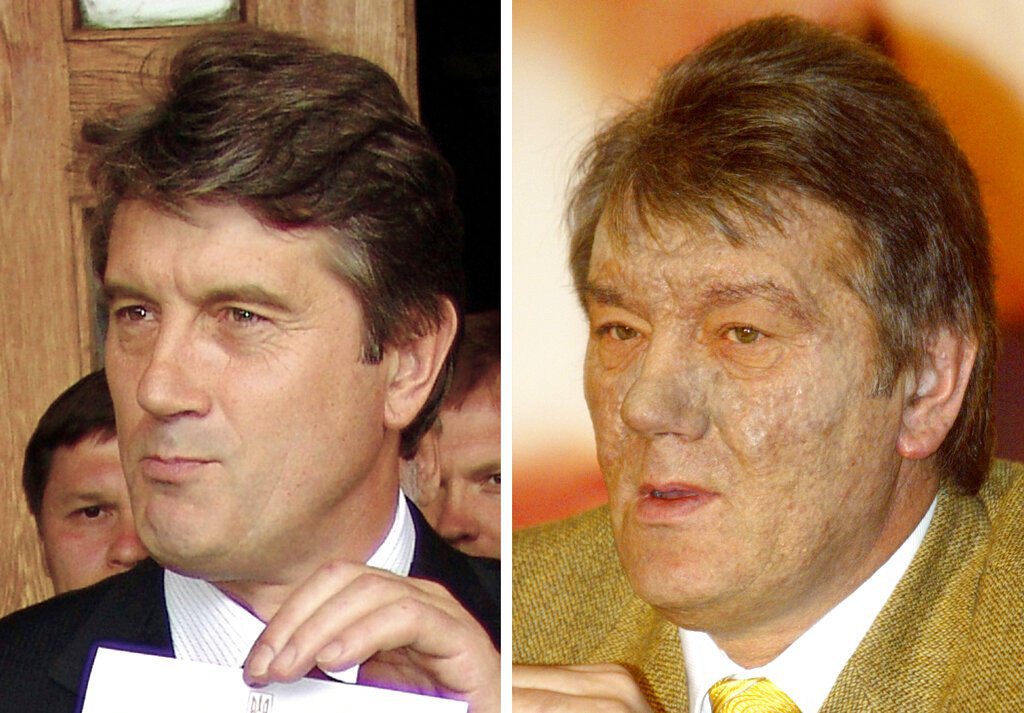 圖為2004年烏克蘭總統大選的親歐派候選人尤申科，圖右為遭到下毒之後之樣貌。 圖／美聯社
