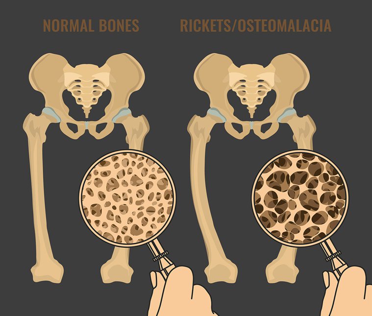 骨骼空洞一撞就碎　骨鬆骨折造成重大健康危機。 圖／聯合報資料庫 提供