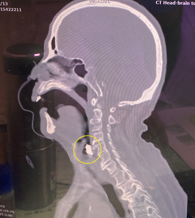 老先生電腦斷層影像，黃圈處為假牙卡住處。圖／南投醫院提供