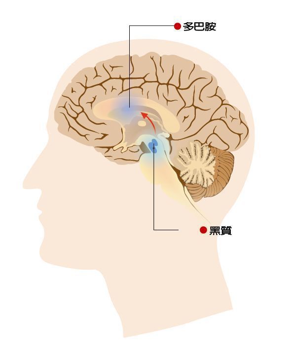 巴金森氏症是一種慢性神經退化疾病，主要是因大腦「黑質」部位退化，神經傳導的多巴胺...