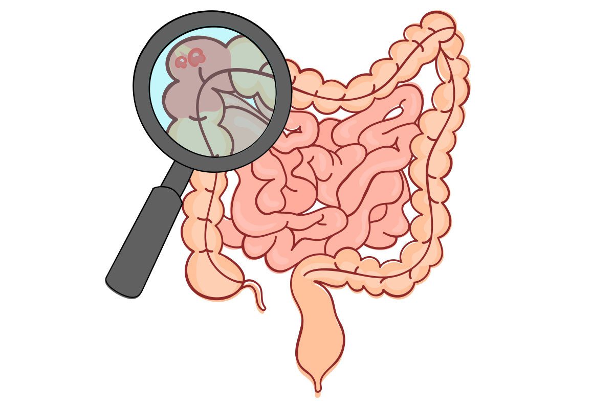 大腸息肉並不少見，而且未必所有的大腸息肉都和大腸癌有關。<br />圖／ingimage