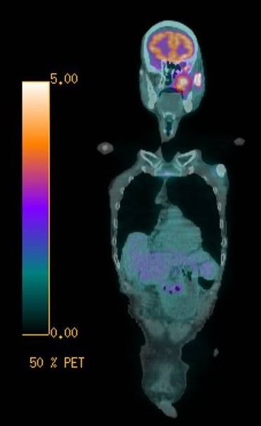 正子攝影顯示鍾姓病人的左側口腔內有腫瘤（紅圈處）。圖／彰化醫院提供
