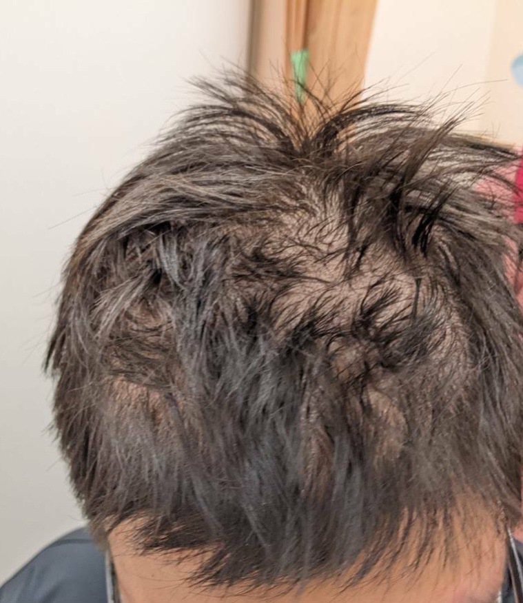 新竹1名健康高二男學生，最近一個月落髮嚴重。圖／中醫大新竹附醫提供