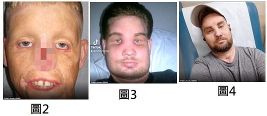 圖2. 杭特車禍經整形手術後的樣子。圖3. 杭特經換臉手術後，臉部腫脹。...