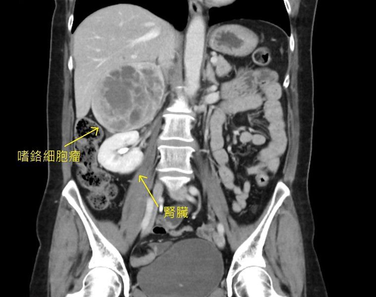 影像檢查中，某些角度嗜鉻細胞瘤看起來已比腎臟還要大 。圖／台北慈濟醫院提供