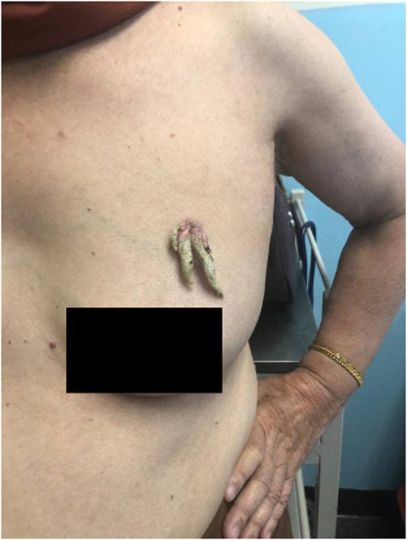 馬來西亞一名女子患上極罕見疾病，左邊胸部竟長出類似「公羊角」的詭異爪狀東西，並持續痕養，需要切除。（sciencedirect）