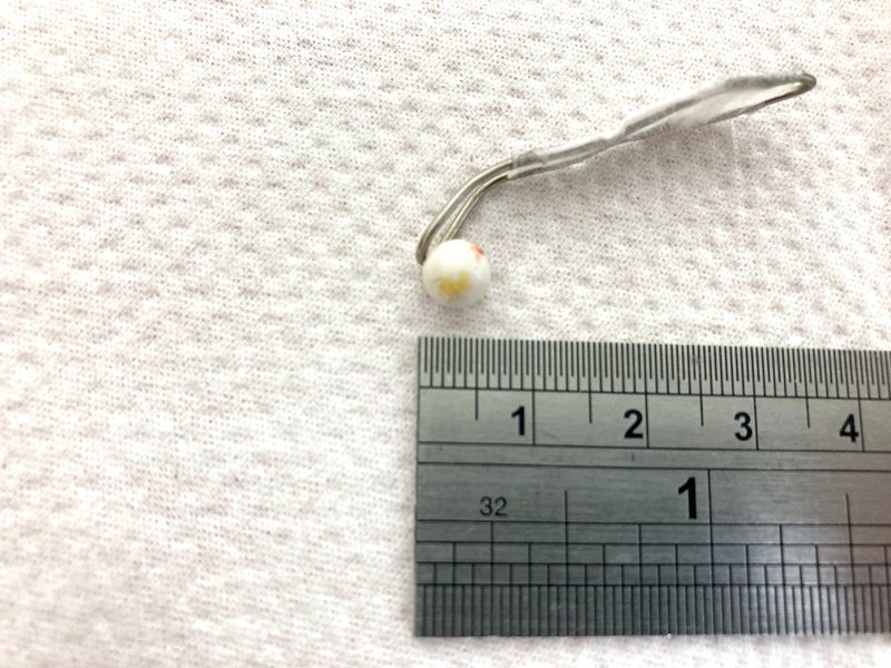 南投醫院醫師利用迴紋針自製勺狀器械，從男童耳內勾出一顆直徑約0.5公分的BB彈。圖／南投醫院提供