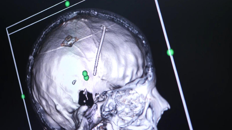 3D扫描显示苏菲亚的头盖骨有个异物。（取自天空新闻）(photo:UDN)
