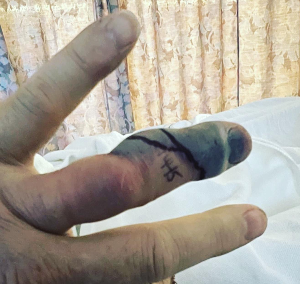 凱瑞艾文斯手指被響尾蛇咬傷後，馬上中毒發黑。圖／摘自IG