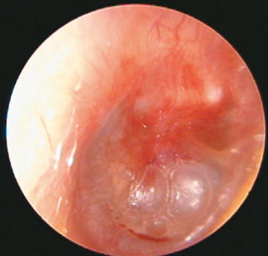 右側急性中耳炎，耳膜嚴重紅腫，中耳腔內有液體。圖／陳建志提供