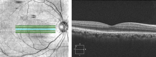 視網膜掃描圖中，正常的黃斑部視網膜下無積液。 圖／台北慈濟醫院提供