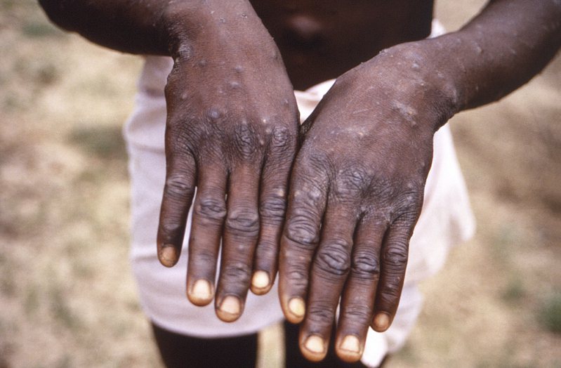 全球多國陸續傳出猴痘（Monkeypox）的確診病例，已至少擴散15國、累積逾百例。美聯