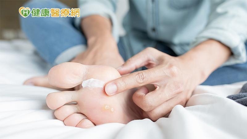 洪崧壬指出，香港腳的成因就是黴菌感染，黴菌喜歡在悶濕、悶熱的環境生長，民眾本身若...