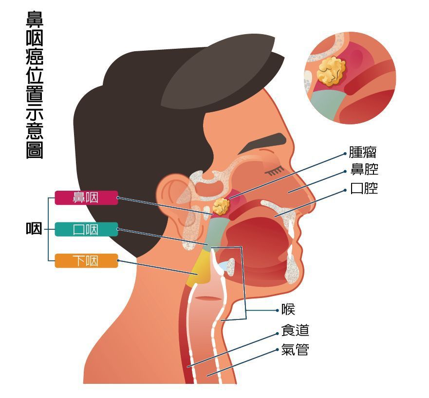 鼻咽癌位置示意圖  圖/123RF