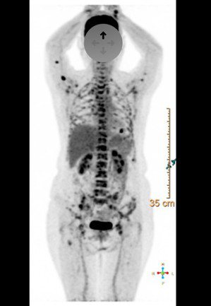 經正子掃描發現患者癌細胞已轉移（黑點處）。圖／張正雄提供