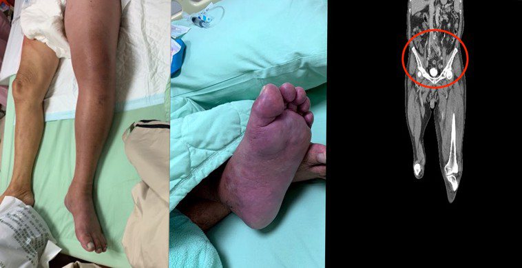 患者左下肢急性腫脹（如左圖），造成足底皮膚顏色已經發紫（中），經過電腦斷層顯示血...