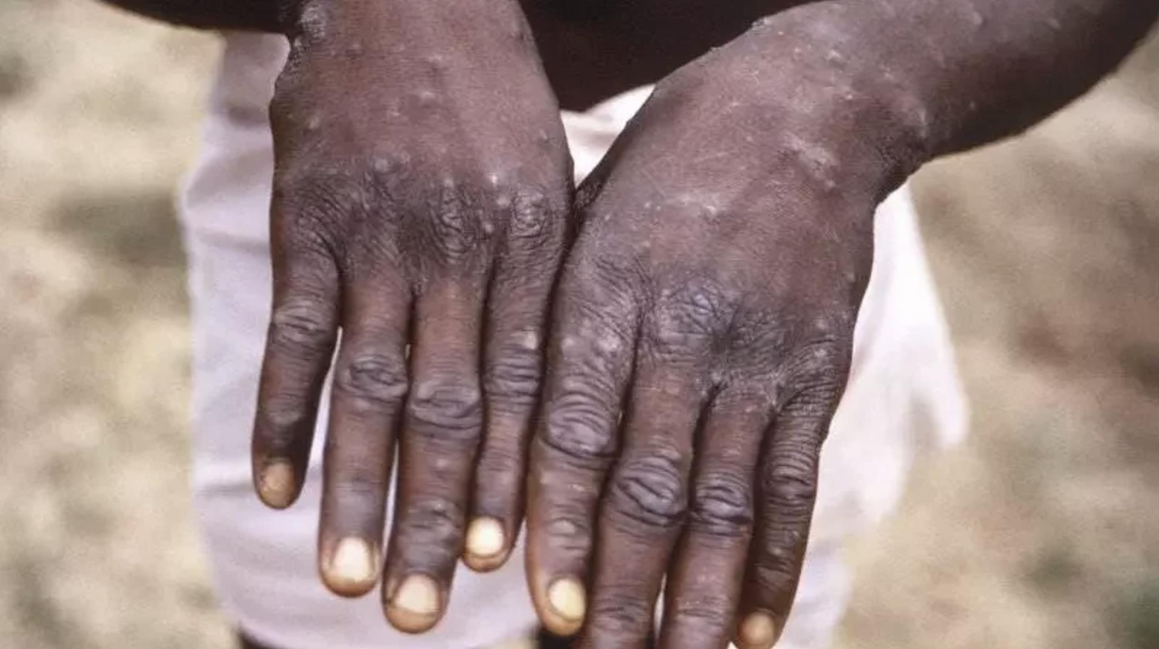 猴痘是一種由猴痘病毒感染所致的人獸共患病毒性疾病，大陸發布的診療指南稱，可通過飛沫傳播。（美聯社資料照）