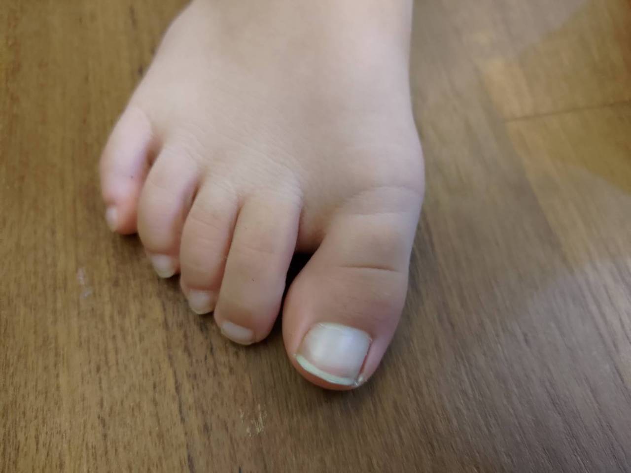 一名男童染疫後手腳指甲全變白嚇壞家長，醫診治發現是長新冠症狀。圖／童綜合醫院提供