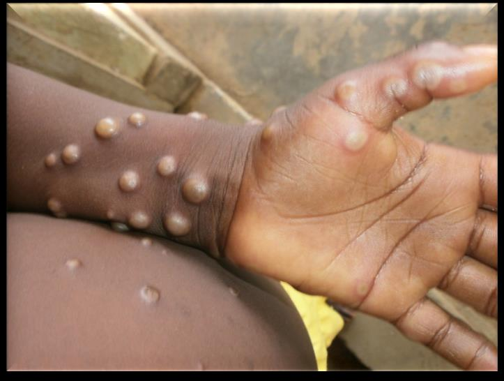 猴痘症狀為嚴重的皮疹，還會有許多其他不適。（圖／取自「中國疾控動態」微信公眾號）