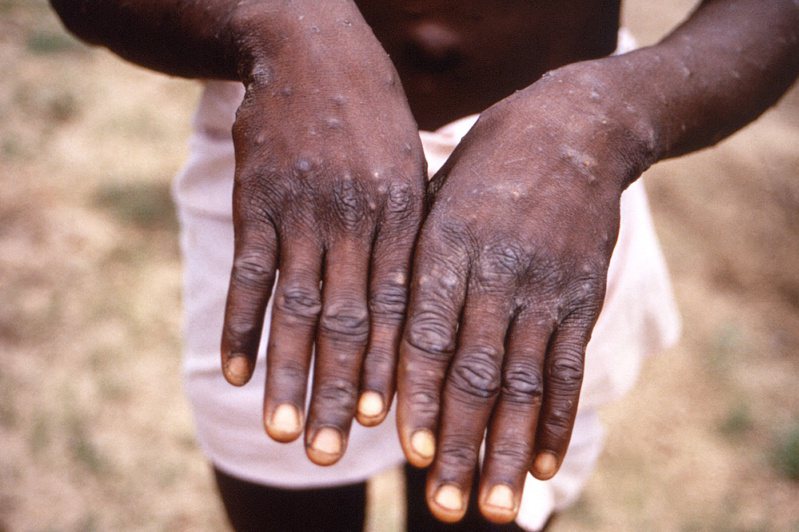 過去一個月全球各地通報一千多個猴痘病例，世衛警告，這種疾病在數十國傳播開來的風險「確實存在」。圖為一名猴痘患者的手。（路透）