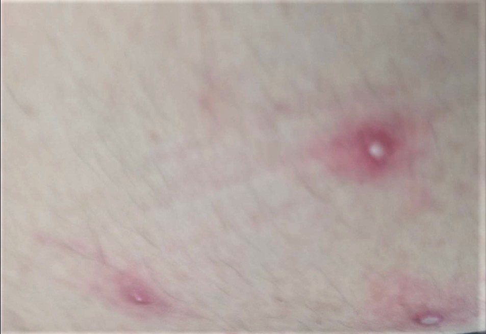 國內首例猴痘確診患者大腿水疱情況。圖／台南市衛生局提供