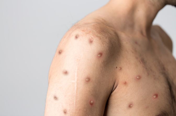 猴痘疫情於多國擴散，我國24日也出現首例25歲男性猴痘案例。 圖／Unsplas...
