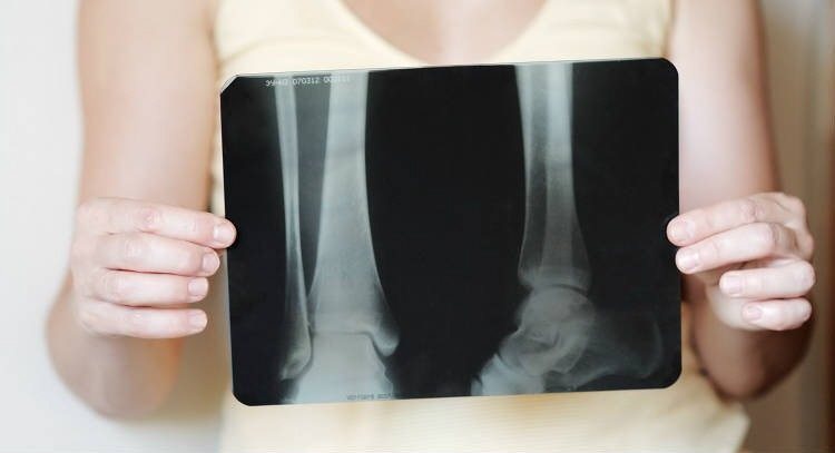 骨鬆病患的骨質脆弱，易發生骨鬆性骨折，若有骨鬆症狀，應積極就醫治療，避免跌倒骨折。圖／報系資料庫