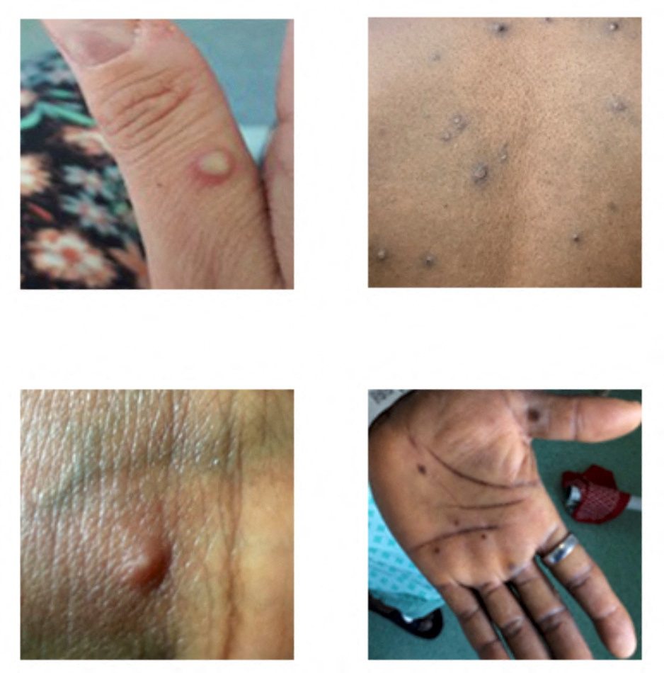CDC官網照片顯示猴痘的皮疹與病灶。（路透）