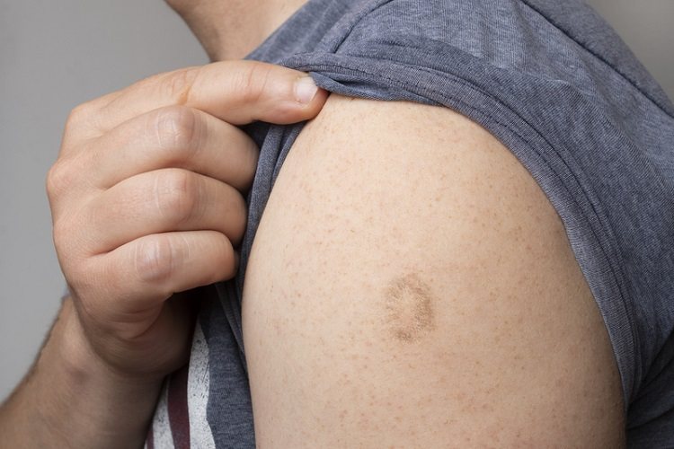 研究顯示天花疫苗對於預防猴痘具有保護力。