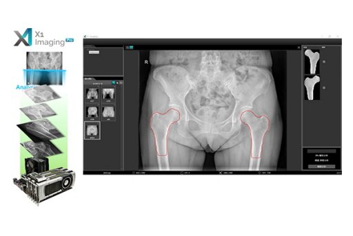 只要一張髖部X光片，電腦就能判讀受檢者有無骨鬆風險，甚至估算未來十年發生骨折的機...