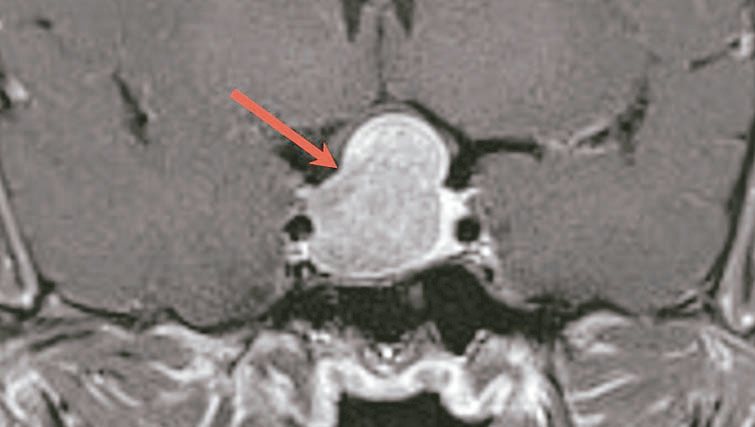 陳先生腦部核磁共振影像的正面切面，紅色箭頭處為腦下垂體腫瘤的位置。圖／馬偕醫院提供