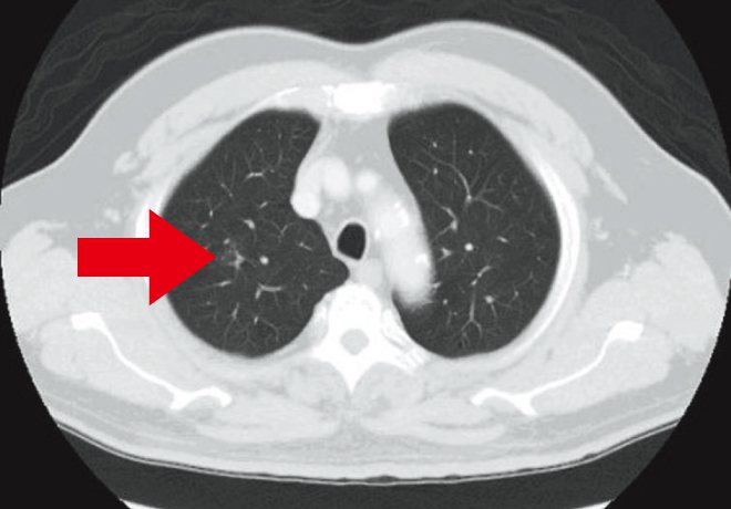 肺部低劑量電腦斷層，箭頭為毛玻璃狀病變。圖／何肇基提供