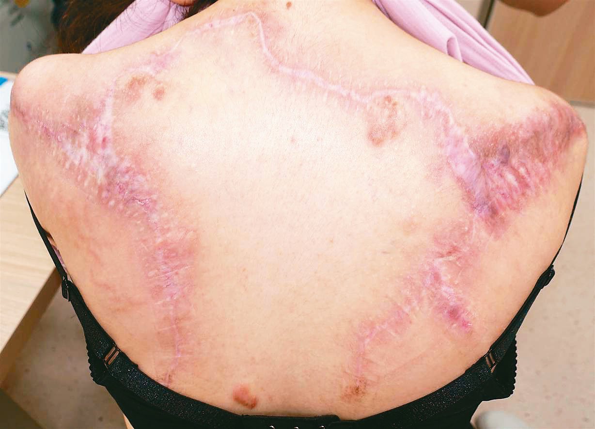 陳小姐背部的青春痘反覆感染長出如「巨蟲」般的蟹足腫，經基隆長庚團隊完成切除治療。圖／長庚醫院提供