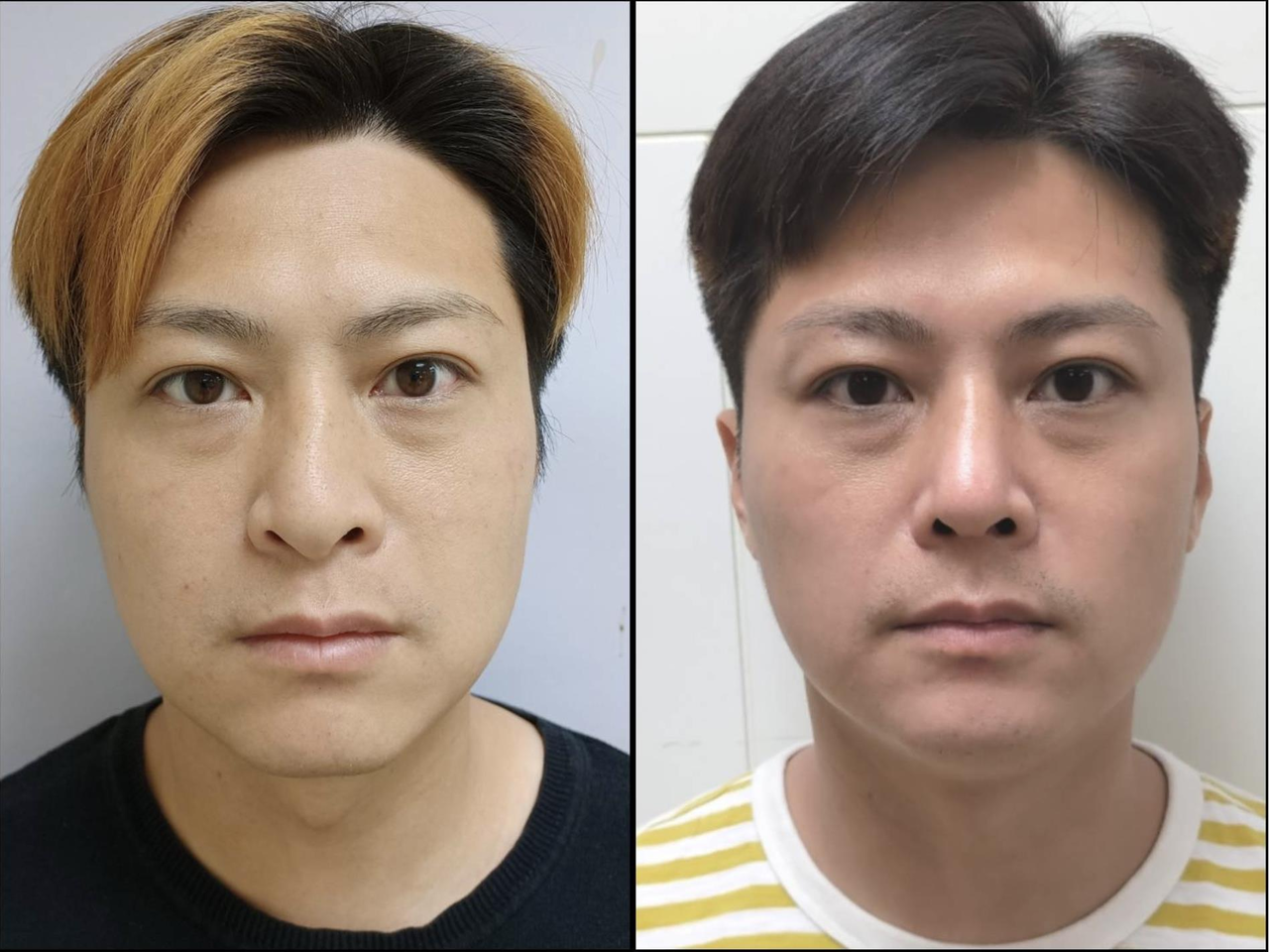 30多歲的陳先生近年鼻型塌陷，經過醫師手術調整，從原先扭曲S鼻型(左)矯正為正常鼻型。圖／三軍總醫院提供