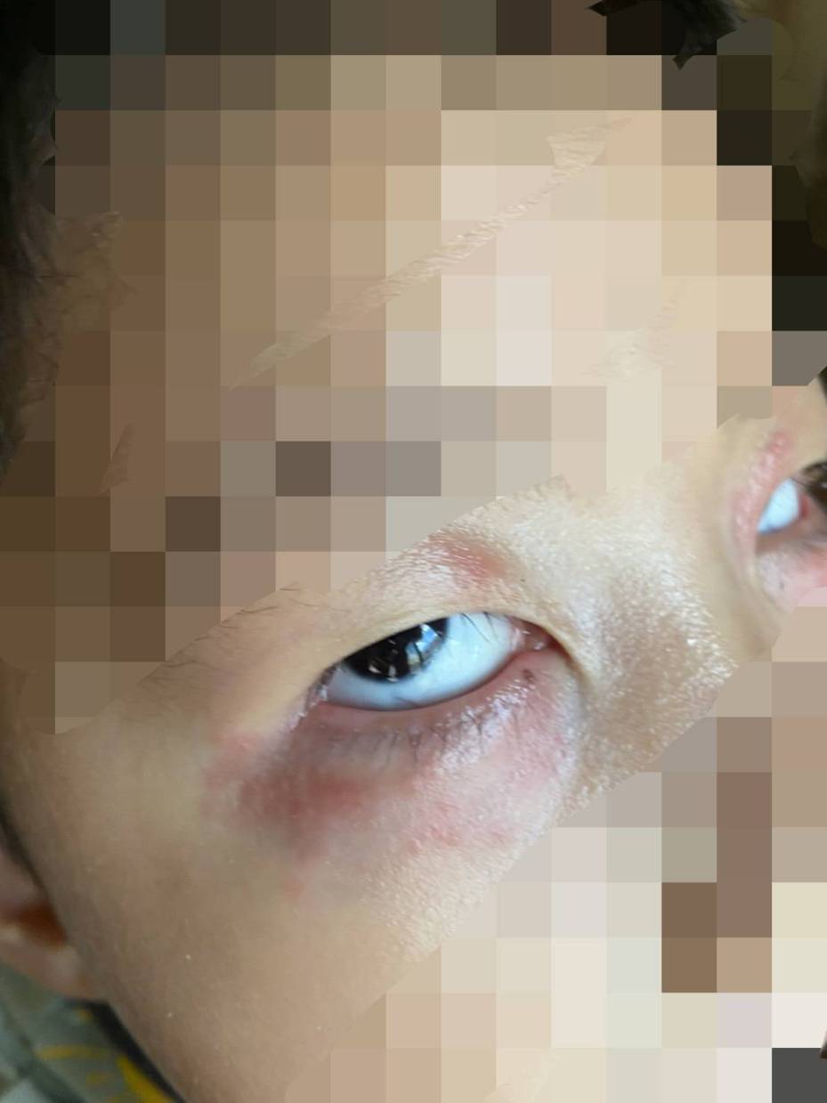 台中市一名５歲男童上月底確診，退燒後眼睛周圍竟出現帶狀皰疹，「皮蛇」繞眼睛一圈，家屬趕緊送醫治療。圖／台中童綜合醫院提供