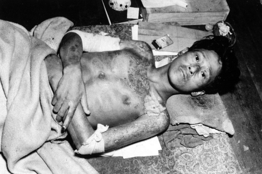在長崎原爆中受害的傷者。 圖／美聯社　