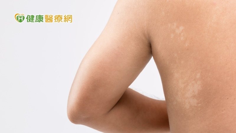 汗斑又稱變色糠疹，它在南台灣濕熱的夏天非常普遍發生。 圖／健康醫療網
